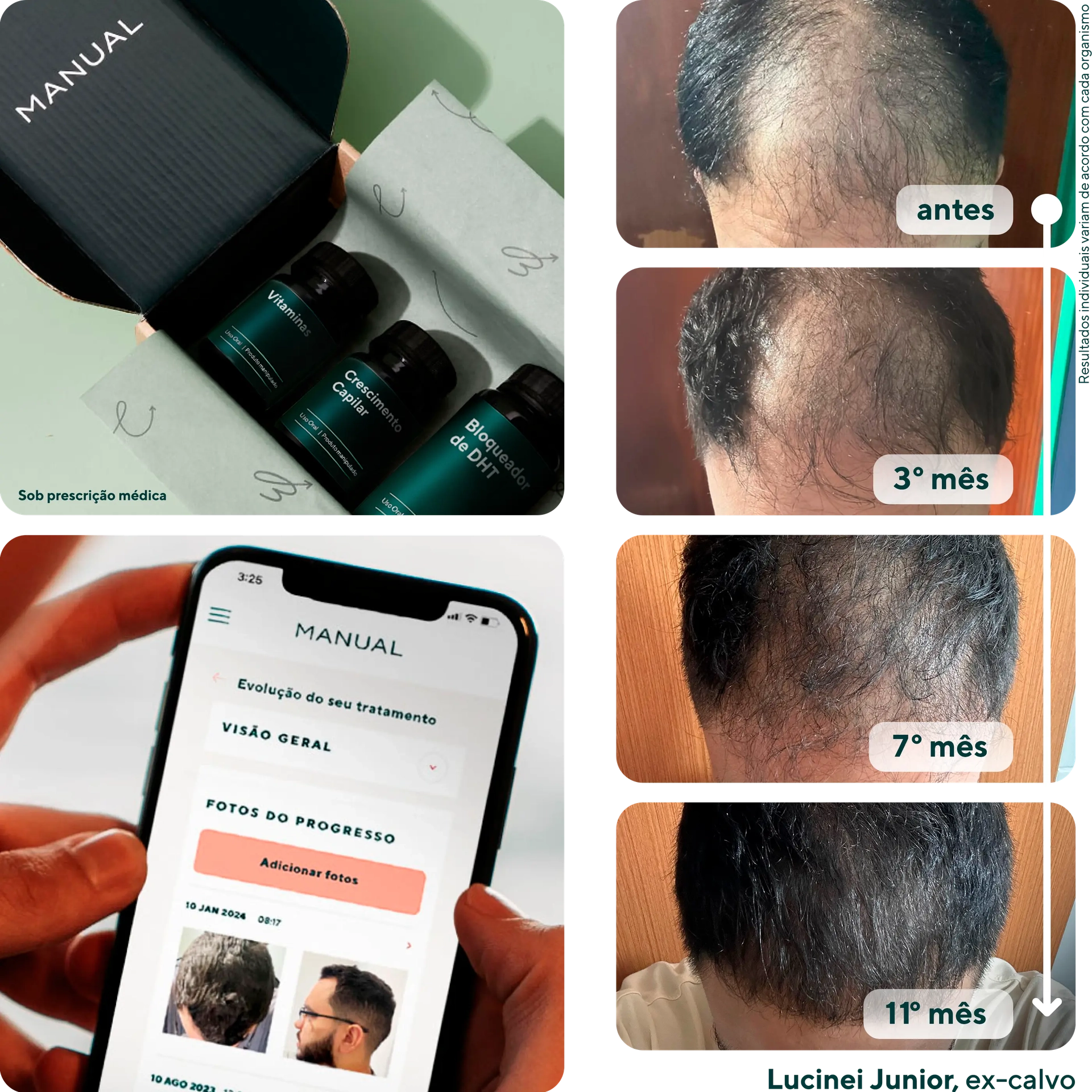 Resultados do tratamento Manual - Progressao de antes, 3 meses, 7 meses e 11 meses mostrando recuperacao capilar