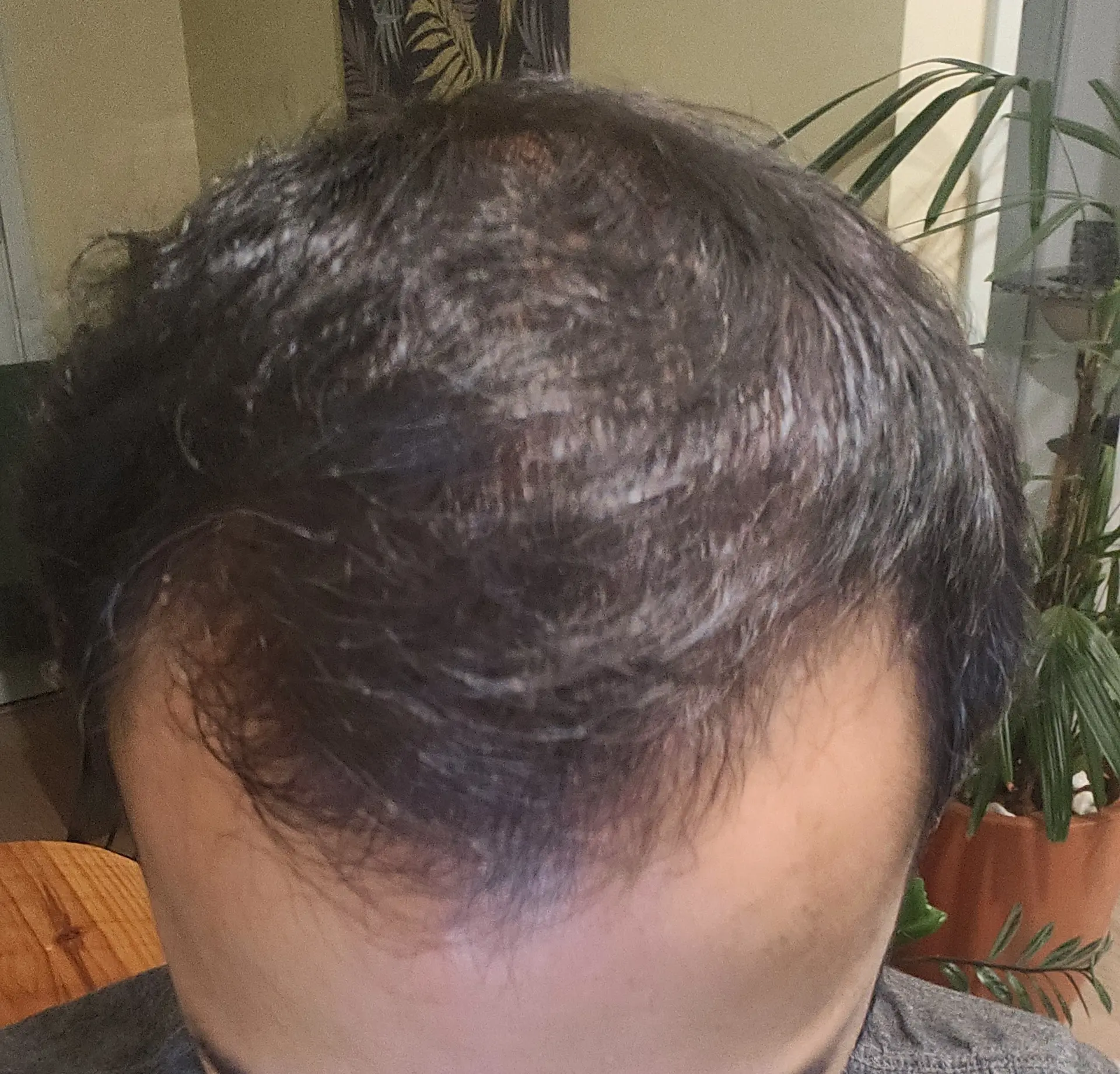 Resultado do tratamento de Roberto L.