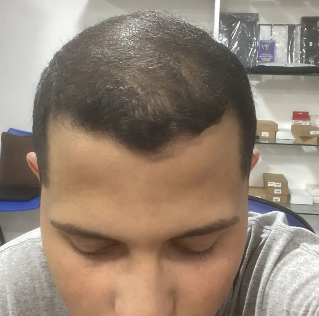 Resultado do tratamento de Felipe G.